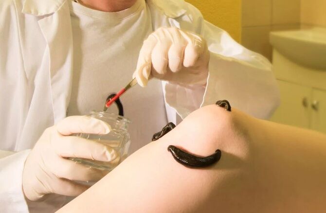 Hirudothérapie pour les varices