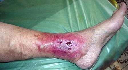 Complications pour les varices