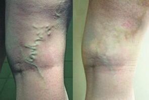 Varices sur les jambes