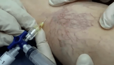 sclérothérapie pour les varices