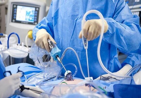 traitement chirurgical des varices pelviennes