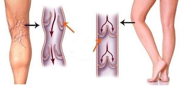 veines saines et varices